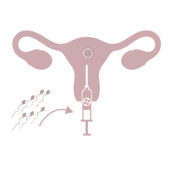 Surrogatefirst traditional surrogacy